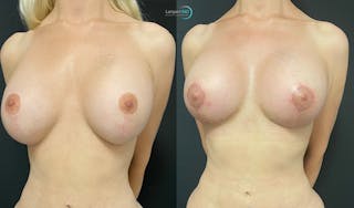 Breast Revision Before & After Gallery - Patient 144554871 - Image 3