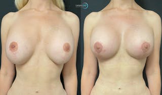 Breast Revision Before & After Gallery - Patient 144554871 - Image 4