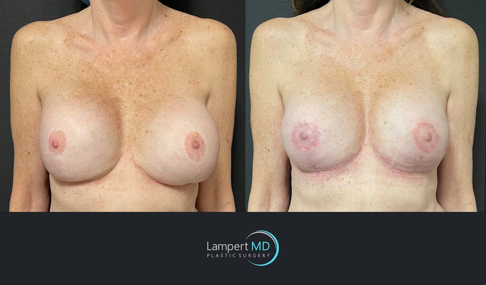 Breast Revision Before & After Gallery - Patient 144554872 - Image 1