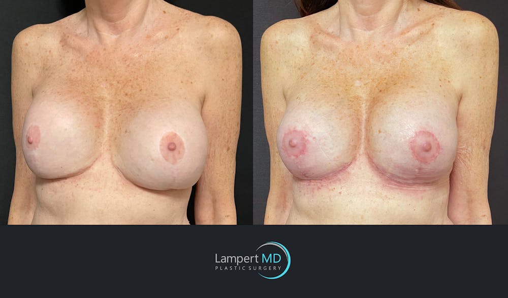 Breast Revision Before & After Gallery - Patient 144554872 - Image 2