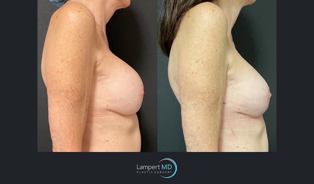 Breast Revision Before & After Gallery - Patient 144554872 - Image 3