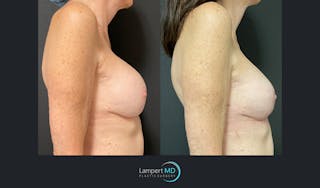 Breast Revision Before & After Gallery - Patient 144554872 - Image 3