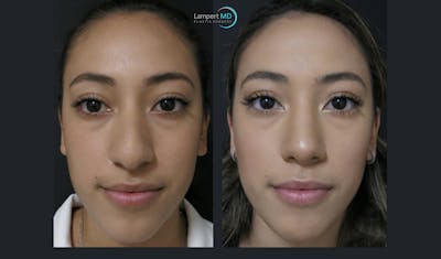 Rhinoplasty Before & After Gallery - Patient 123815980 - Image 1