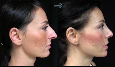 Rhinoplasty Before & After Gallery - Patient 123816065 - Image 1