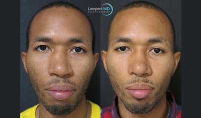 Nasal Fracture Before & After Gallery - Patient 122908680 - Image 1