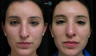Nasal Fracture Before & After Gallery - Patient 122908673 - Image 1