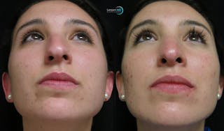 Nasal Fracture Before & After Gallery - Patient 122908673 - Image 2