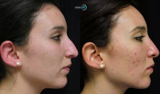 Nasal Fracture Before & After Gallery - Patient 122908673 - Image 4