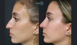 Rhinoplasty Before & After Gallery - Patient 123815997 - Image 3