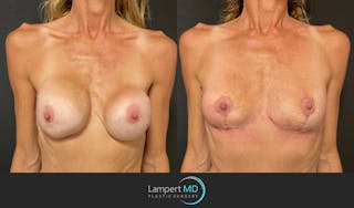 Breast Explant Before & After Gallery - Patient 148370092 - Image 1