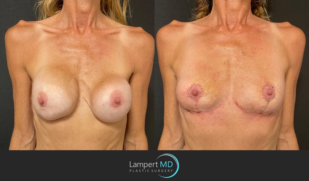 Breast Explant Before & After Gallery - Patient 148370092 - Image 1