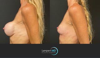 Breast Explant Before & After Gallery - Patient 148370092 - Image 2