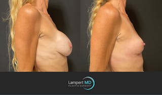 Breast Explant Before & After Gallery - Patient 148370092 - Image 3
