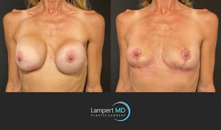 Breast Explant Before & After Gallery - Patient 148370092 - Image 4