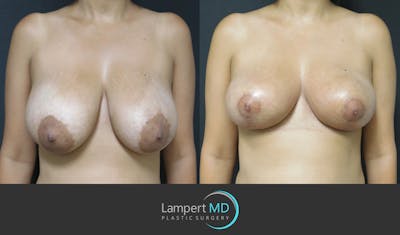 Breast Lift Before & After Gallery - Patient 146866245 - Image 1