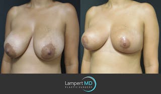 Breast Reduction Before & After Gallery - Patient 146866238 - Image 2