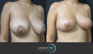 Breast Reduction Before & After Gallery - Patient 146866238 - Image 3