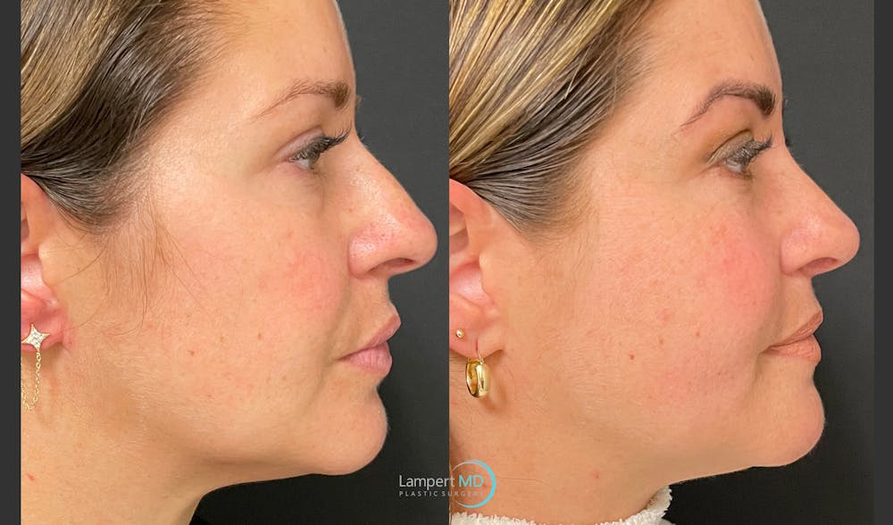 Rhinoplasty Before & After Gallery - Patient 123816075 - Image 1