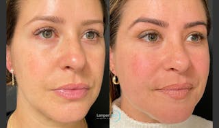 Rhinoplasty Before & After Gallery - Patient 123816075 - Image 2