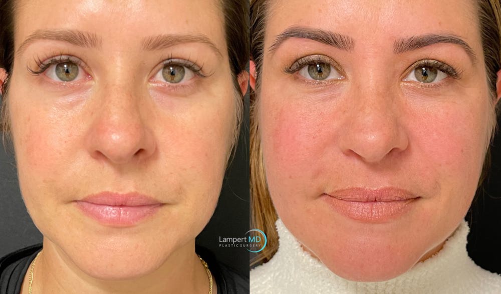 Rhinoplasty Before & After Gallery - Patient 123816075 - Image 3