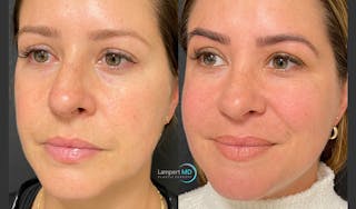 Rhinoplasty Before & After Gallery - Patient 123816075 - Image 4