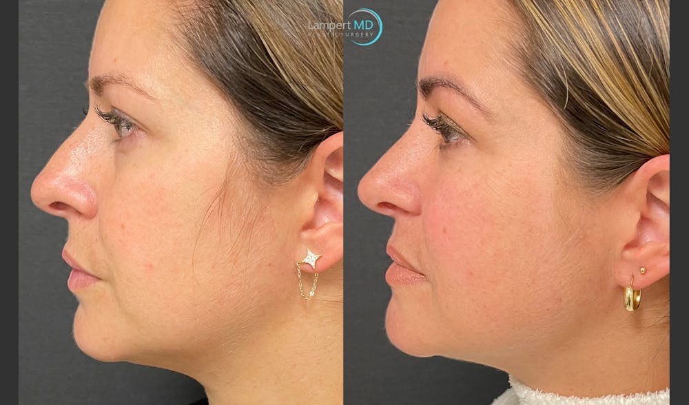 Rhinoplasty Before & After Gallery - Patient 123816075 - Image 5