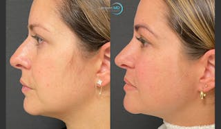 Rhinoplasty Before & After Gallery - Patient 123816075 - Image 5