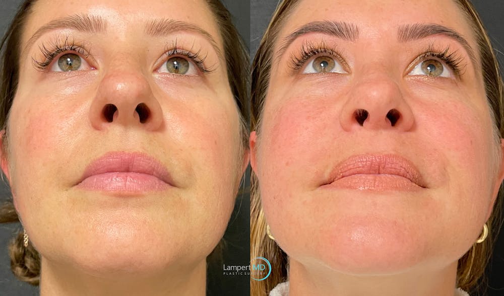 Rhinoplasty Before & After Gallery - Patient 123816075 - Image 6
