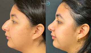 Rhinoplasty Before & After Gallery - Patient 148352815 - Image 1