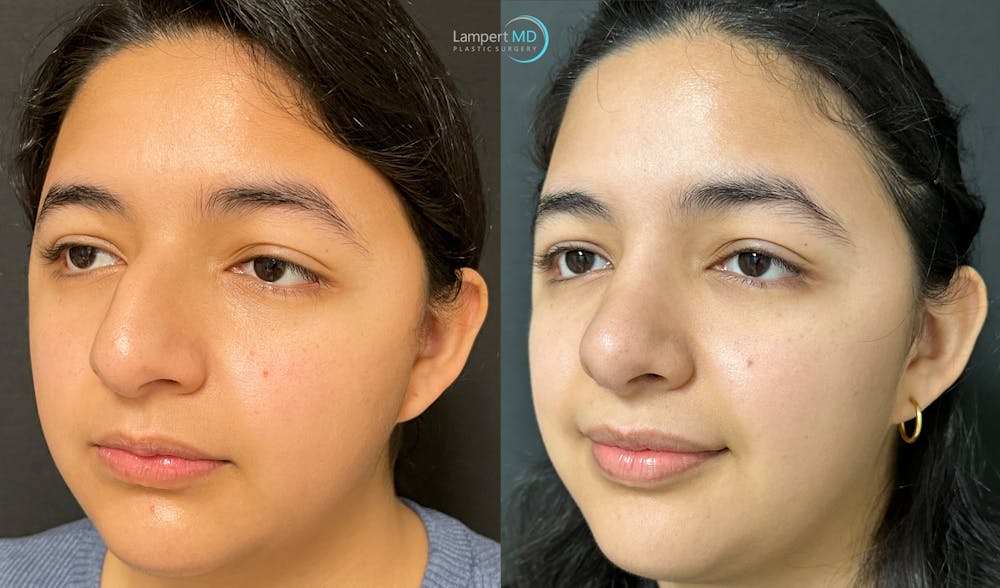 Rhinoplasty Before & After Gallery - Patient 148352815 - Image 2