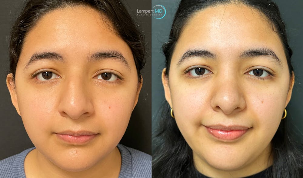 Rhinoplasty Before & After Gallery - Patient 148352815 - Image 3