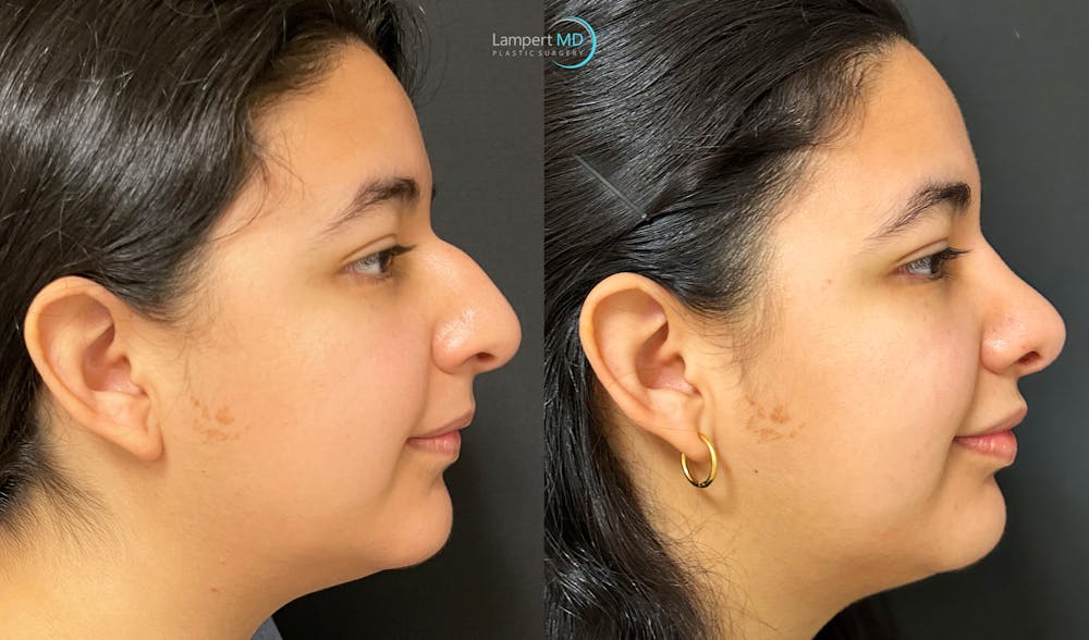 Rhinoplasty Before & After Gallery - Patient 148352815 - Image 4