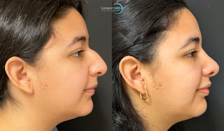 Rhinoplasty Before & After Gallery - Patient 148352815 - Image 4