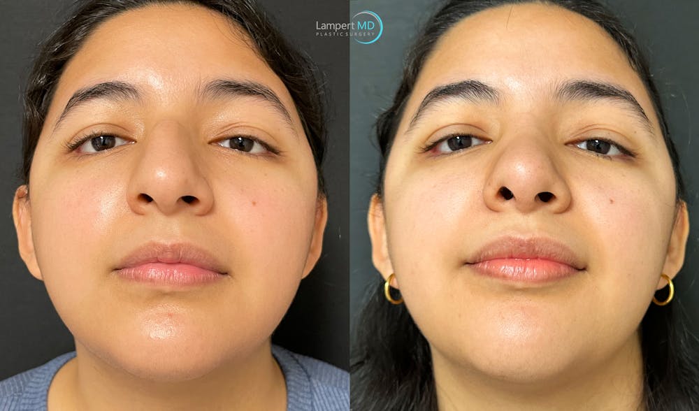 Rhinoplasty Before & After Gallery - Patient 148352815 - Image 5