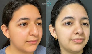 Rhinoplasty Before & After Gallery - Patient 148352815 - Image 6