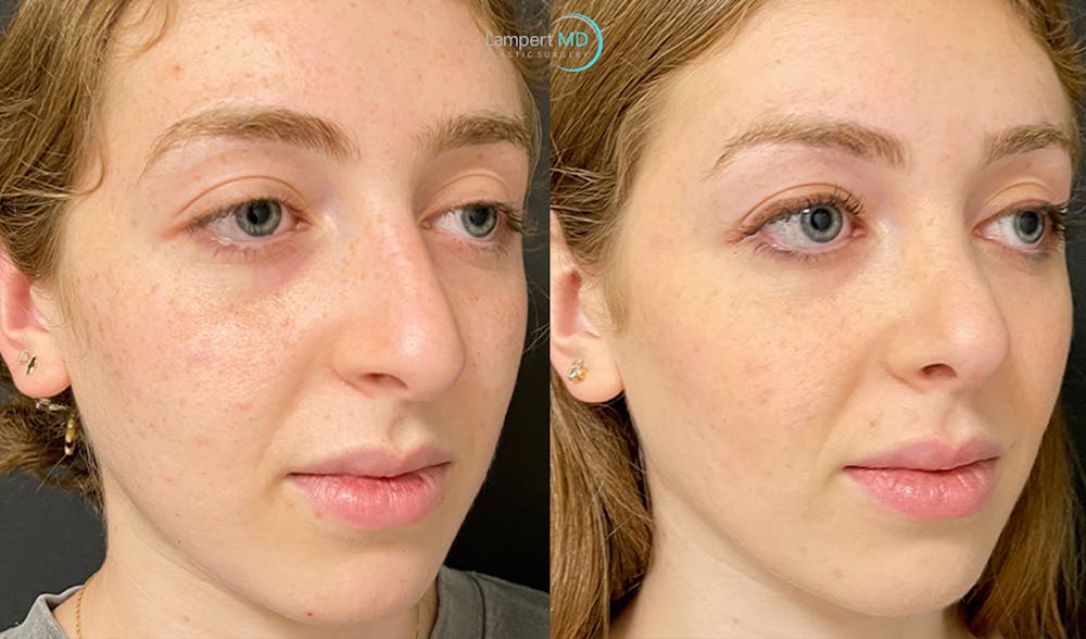 Rhinoplasty Before & After Gallery - Patient 123816240 - Image 1
