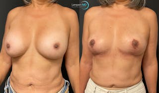 Breast Explant Before & After Gallery - Patient 148370094 - Image 2