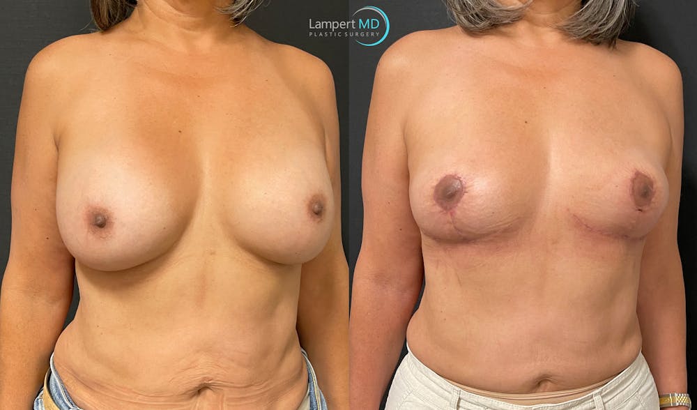 Breast Explant Before & After Gallery - Patient 148370094 - Image 3