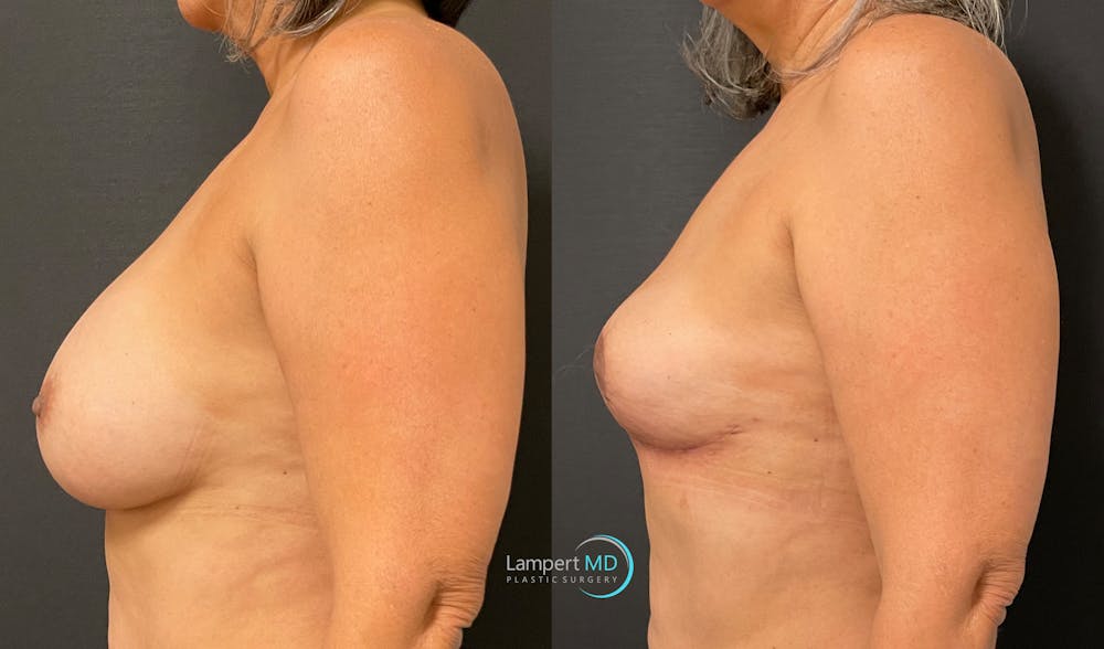 Breast Explant Before & After Gallery - Patient 148370094 - Image 4
