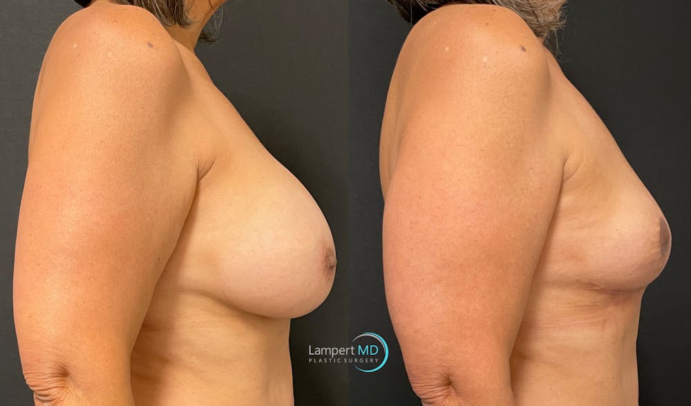 Breast Explant Before & After Gallery - Patient 148370094 - Image 5