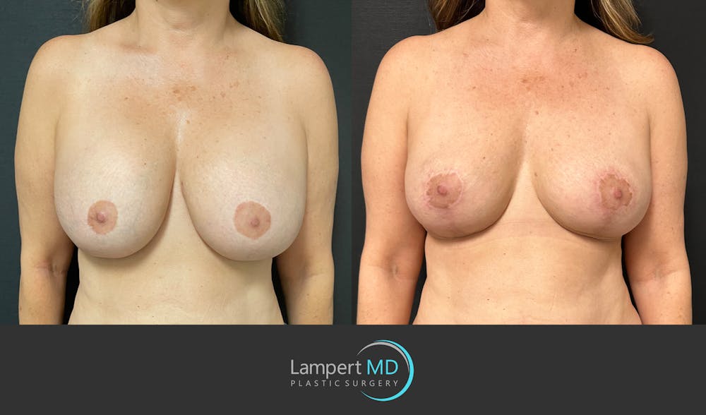 Breast Explant Before & After Gallery - Patient 148370106 - Image 1