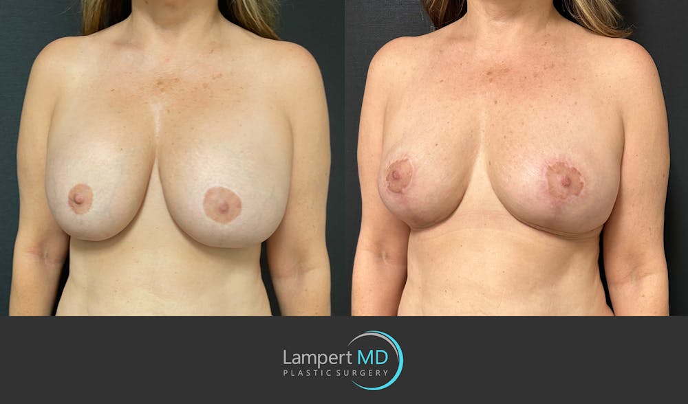 Breast Explant Before & After Gallery - Patient 148370106 - Image 2