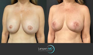 Breast Explant Before & After Gallery - Patient 148370106 - Image 2