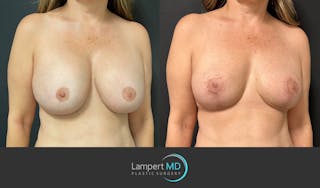 Breast Explant Before & After Gallery - Patient 148370106 - Image 3