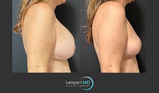 Breast Explant Before & After Gallery - Patient 148370106 - Image 4