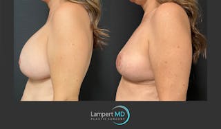 Breast Explant Before & After Gallery - Patient 148370106 - Image 5