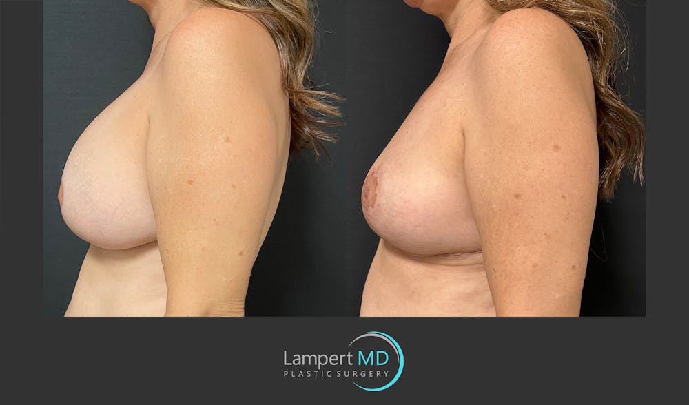 Breast Explant Before & After Gallery - Patient 148370106 - Image 5