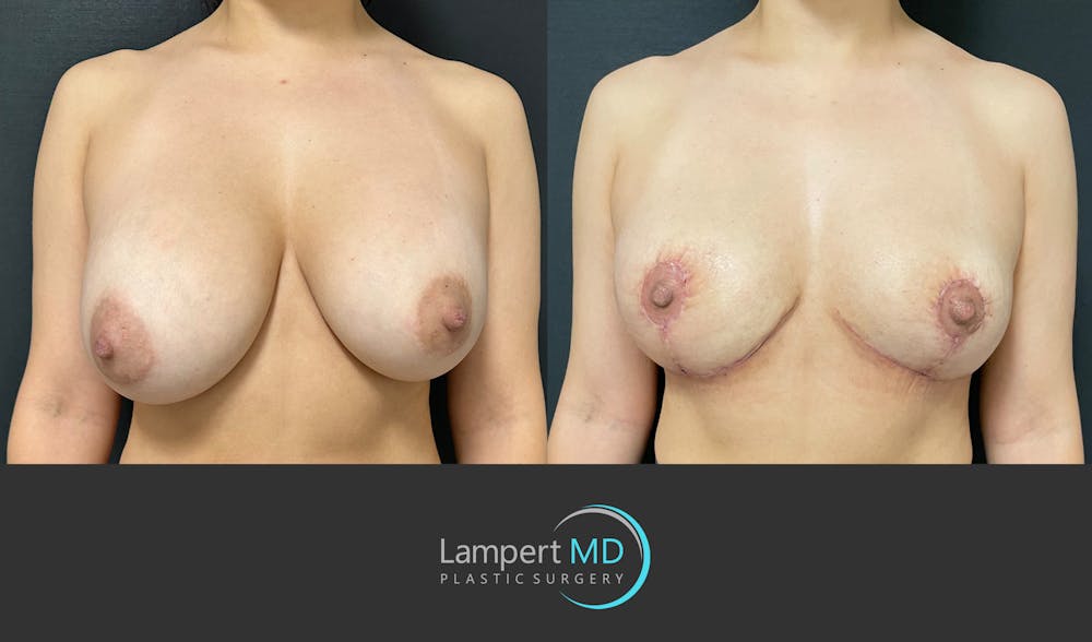 Breast Explant Before & After Gallery - Patient 148370137 - Image 1