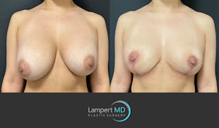 Breast Explant Before & After Gallery - Patient 148370137 - Image 1