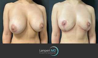 Breast Explant Before & After Gallery - Patient 148370137 - Image 2